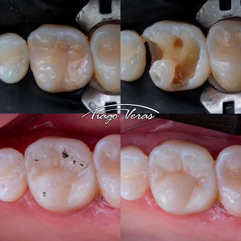 resina composta posterior