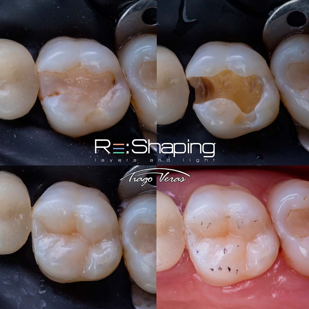 resina posterior