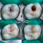 resina posterior