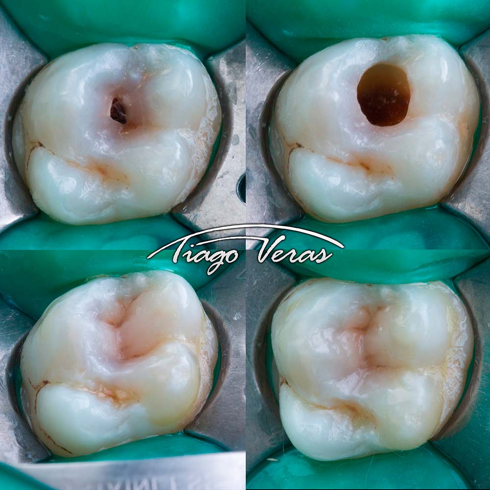 resina posterior